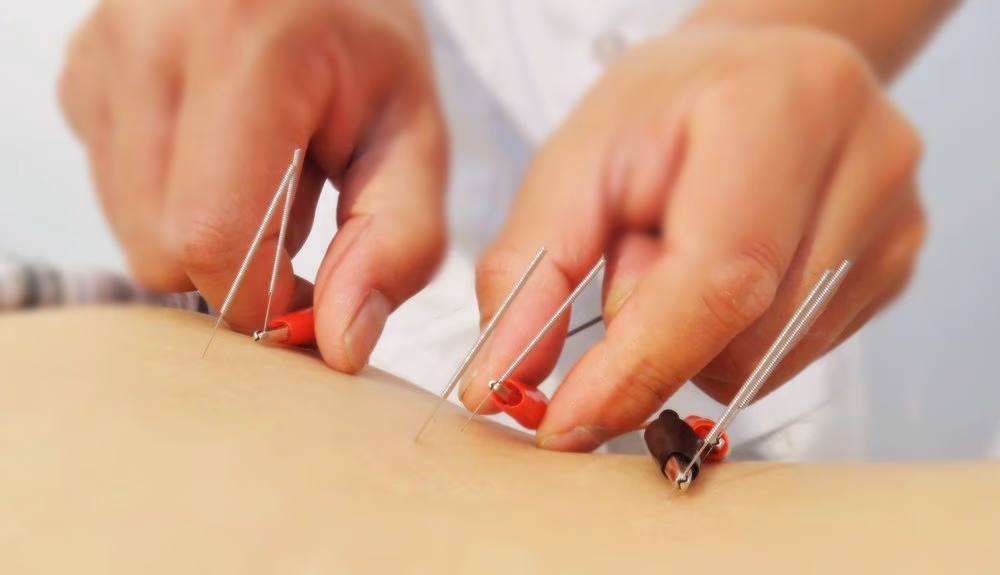 Imagen relacionada con Qué es y cuáles son los beneficios de la electroacupuntura